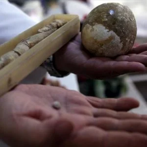 حصوات الكلى.. أثمن المقتنيات في عيادة طبيب تركي