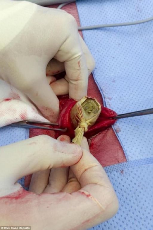 لاجئ سوري يلجأ لحيلة كادت ان تودي بحياته لحماية أمواله.. هكذا خبأ 1800 دولار 3