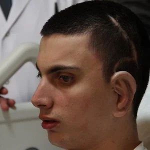 للمرة الأولى في العالم.. زرع أذن مستخلصة من غضروف حي في تركيا