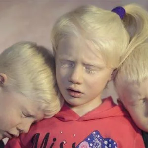 تركيا.. المصابون بالمهق “ملائكة بيضاء” تشق طريقها في دروب الحياة