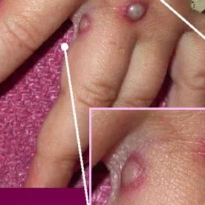 فيروس قاتل يهدد العالم.. وباحثون يسابقون الزمن بحثا عن لقاح