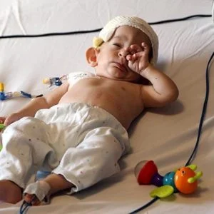 أطباء أتراك ينجحون بمعالجة رضيع سوري يعاني من تشوه في الجمجمة