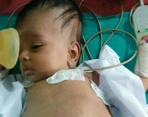 شخّصوا حالته بأنه يعاني من ورم في بطنه فكانت الصدمة ما وجدوه خلال العملية.. توأمه مكتمل داخل معدته ويتغذى منه!!