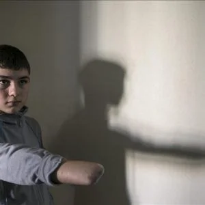 طفل سوري يأمل بالحصول على يد صناعية في تركيا