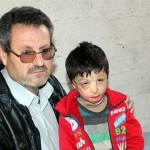 محمود.. طفل سوري أحرقته براميل النظام وينتظر العلاج في تركيا