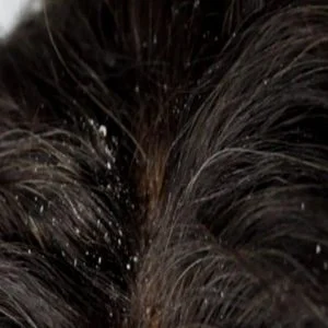 بدون مواد كيميائية.. تخلص من قشرة الرأس بكل سهولة!!