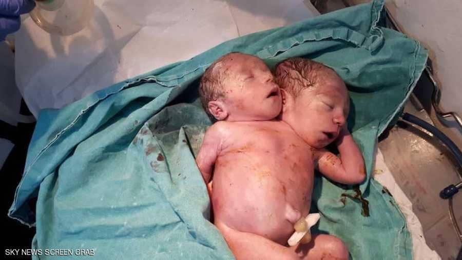 بالصور.. حالة نادرة لولادة طفل سوري "برأسين" 3