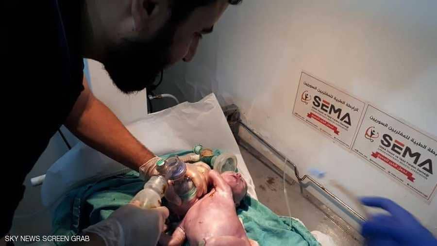 بالصور.. حالة نادرة لولادة طفل سوري "برأسين" 1