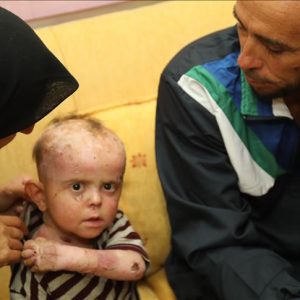 “İHH” تحضر طفلا سوريا مصابا بـ”الفقاع” إلى تركيا للعلاج