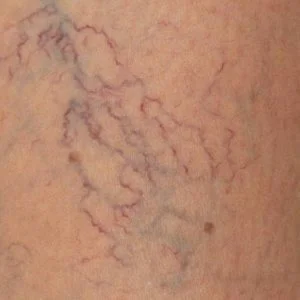 4 نصائح تضمن لك الوقاية من دوالي الساقين