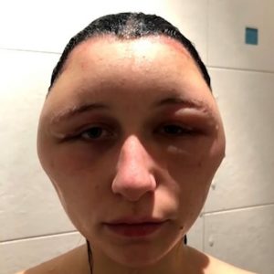 شاهد.. بسبب صبغة الشعر .. وجه فتاة جميلة يتحول إلى كرة 3