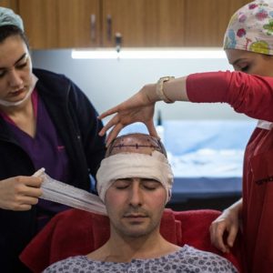 تركيا تجني أكثر من مليار دولار في 2018 من عمليات زراعة الشعر