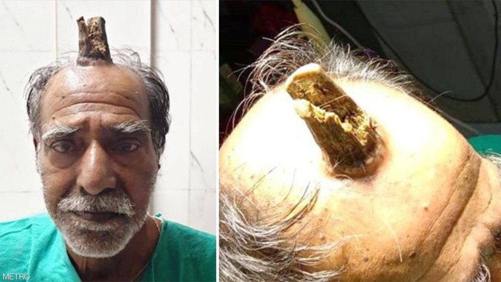 بعدما زاد عن حده.. اضطر إلى استئصال "قرن الشيطان".. "صور" 3