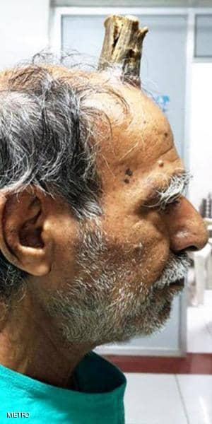 بعدما زاد عن حده.. اضطر إلى استئصال "قرن الشيطان".. "صور" 1