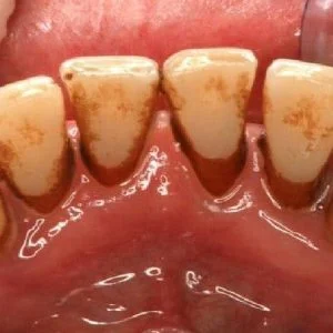 إليكم وصفة فعالة للتخلص من طبقة الجير التى ترهق الأسنان و اللثة!