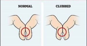 من خلال فحص بسيط للإصبع يمكن الكشف المبكر للإصابة بسرطان الرئة (صورة) 1