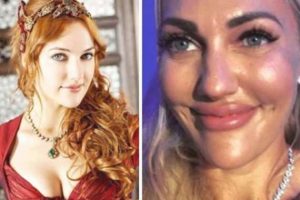 فنانة تركية شهيرة تكشف سر تشويه وجهها بـ البوتكس!!