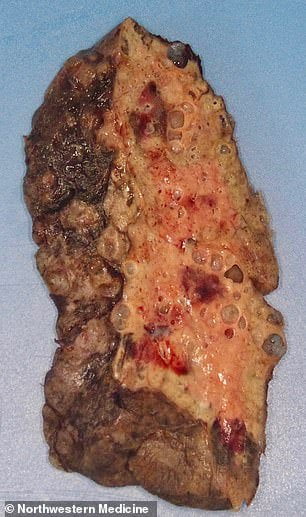 فيروس كورونا يدمر رئة فتاة عشرينية بطريقة صادمة (صور) 1