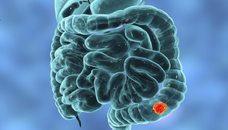 سرطان الأمعاء