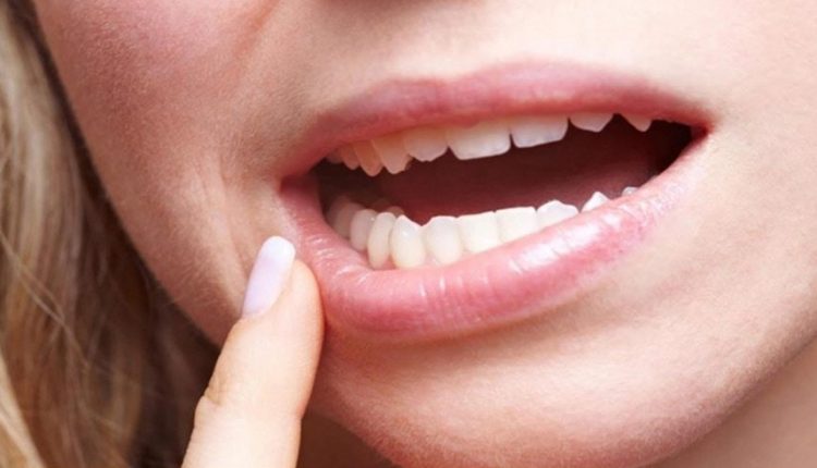 علاج فطريات الفم واللسان بالاعشاب الطبية