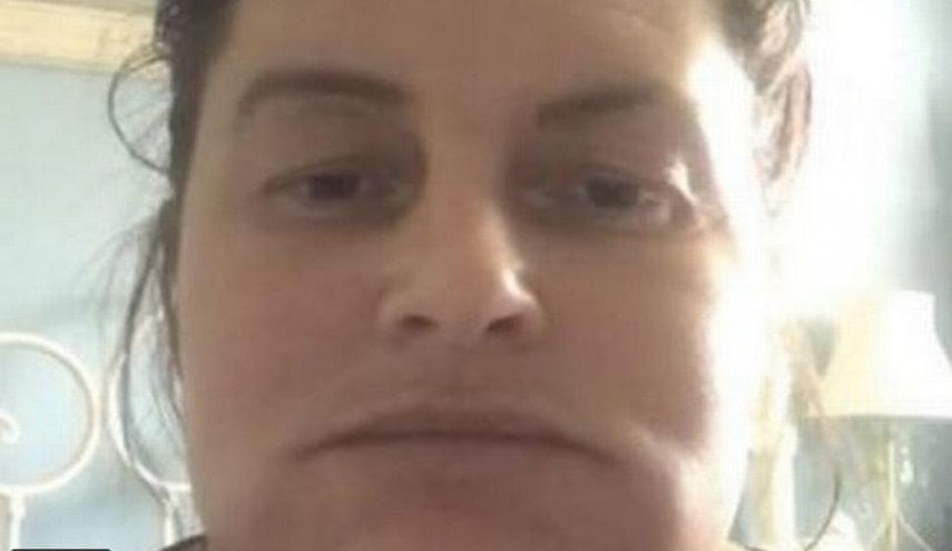 حقنة تجميل تحول وجه سيدة بريطانية إلى "قائمة فيل" 15