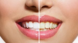 علاجات منزلية لأسنان ناصعة البياض