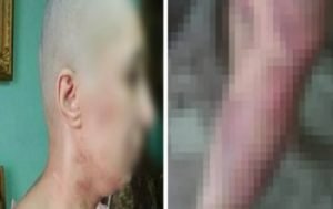 مصري يحلق شعر زوجته ويطفئ السجائر في جسدها
