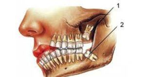 لماذا سـُـمي ب "ضرس العقل" و ما هي اعراضه 9
