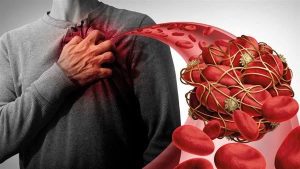 طبيبة تكشف سبب زيادة الإصابة بالجلطة الدموية في الشتاء