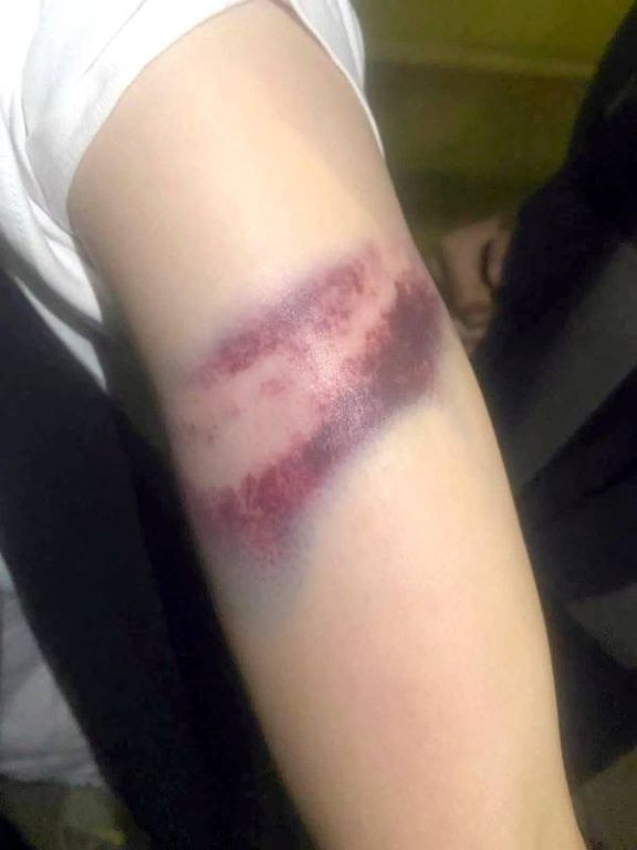 صورة تظهر آثار الضرب لإحدى فتيات دار الأيتام في السعودية 1