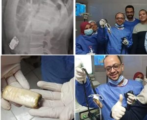 بالصور: أطباء يستخرجون هاتف من معدة شاب مصري