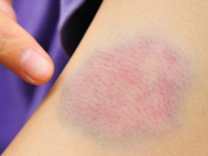 4 أسباب تؤدي لظهور الكدمات فجأة في الجسم.. تعرف عليها