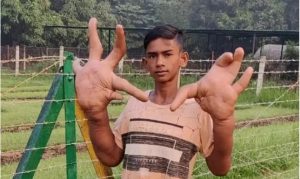 طفل الشيطان.. مراهق هندي يعاني من متلازمة نادرة جعلت يديه بضخامة القدمين| صورة 