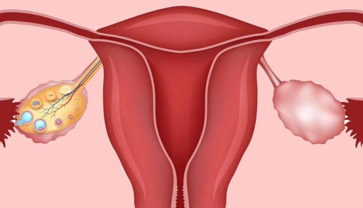 تكيسات المبايض ونسبة نجاح الحقن المجهري