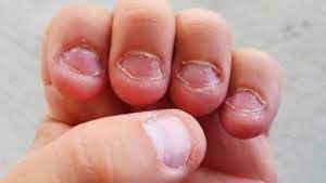 طبيبة روسية تكشف أسباب قضم الأظافر