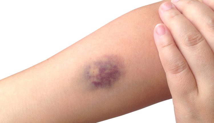 أسباب ظهور بقع زرقاء في الجسم