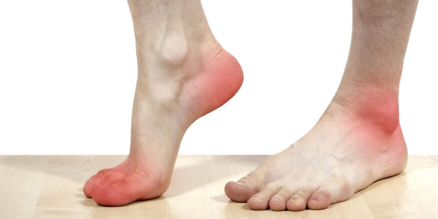 أسباب احمرار القدمين عند الوقوف والعلاج المناسب 1
