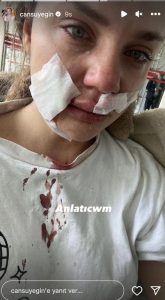 تعتني به منذ 8 سنوات.. كلب يهاجم مشهورة تركية ويصيبها بجروح خطيرة "صور" 3