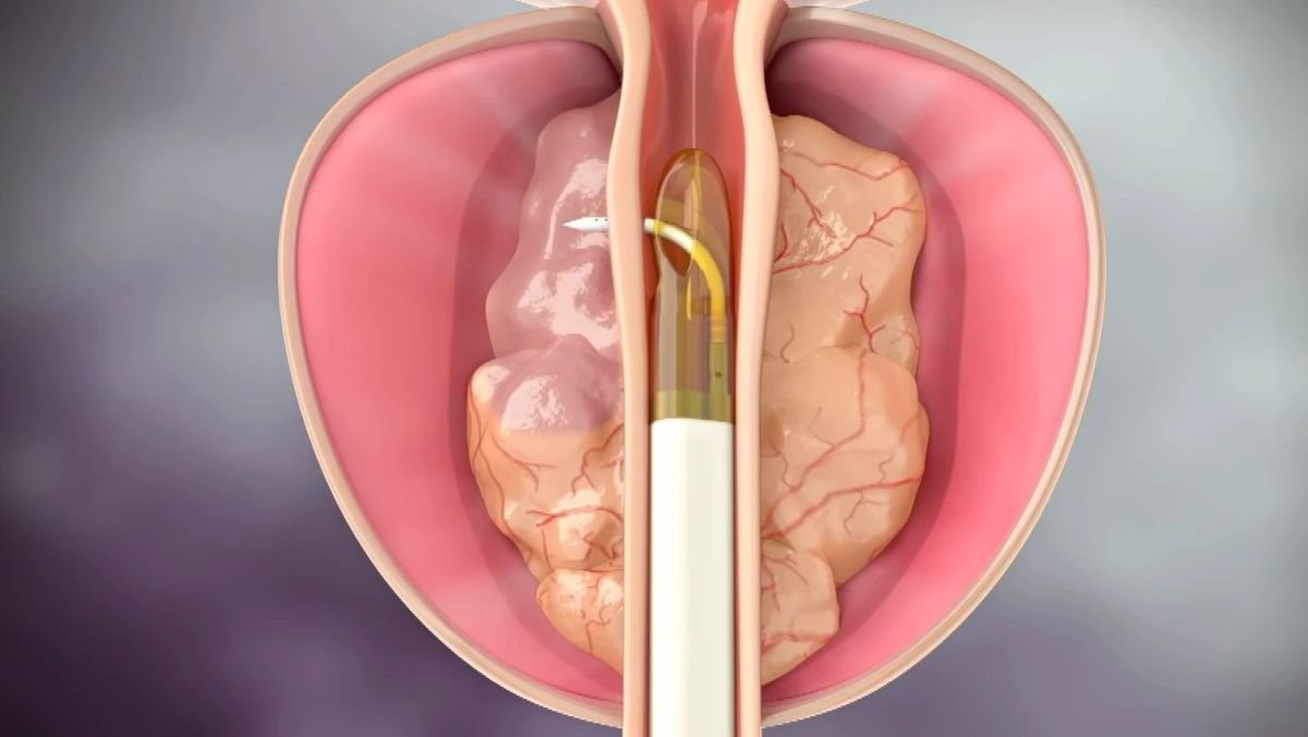 سرطان البروستاتا يهدد 1 من كل 9 رجال: تعرف على الأعراض المبكرة وخيارات علاج 1