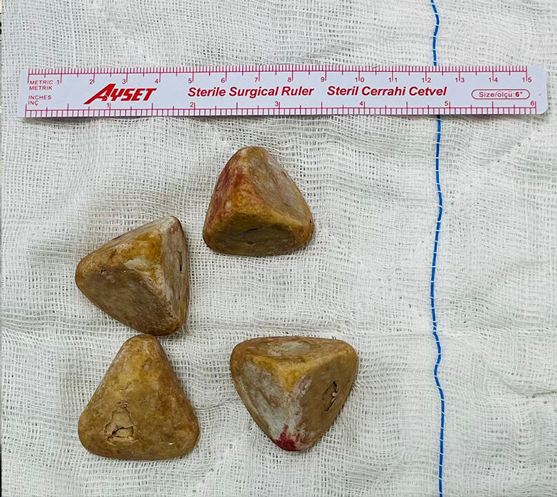 مفاجأة طبية في أيدين: حصوات مريض تثير الدهشة بين الأطباء! 1